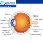 Retinal detachment in Iran