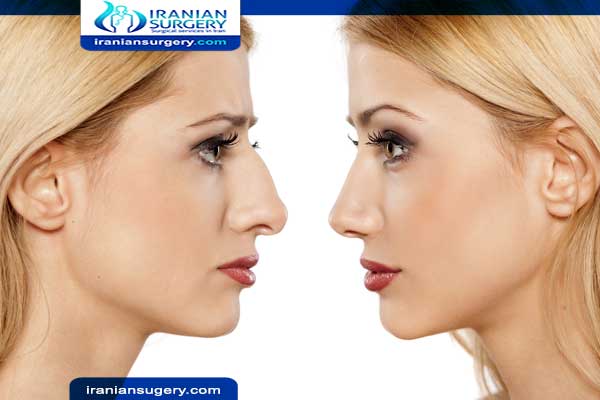 Rhinoplasty surgery