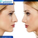 Bad Rhinoplasty