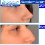 dr Ein abadi Rhinoplasty surgery