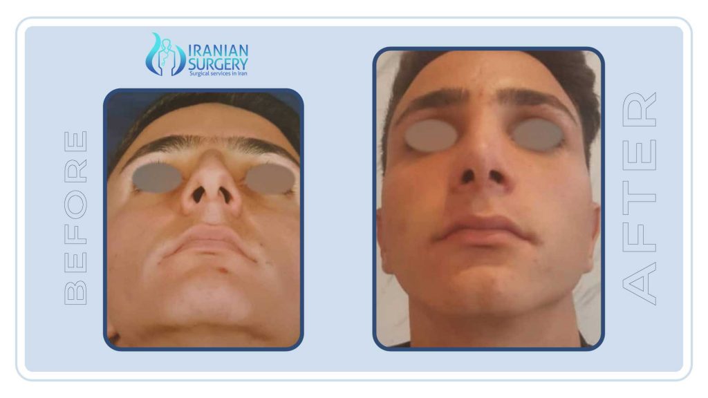  Rhinoplasty in Iran before and after