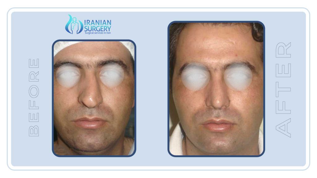  Rhinoplasty in Iran before and after
