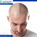 Scalp micropigmentation