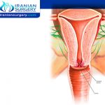 Stages of Cervical Cancer