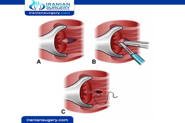 Stages of fissure healing