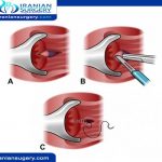 colorectal cancer treatment