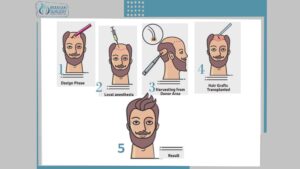 Hair Transplant Process in Iran 