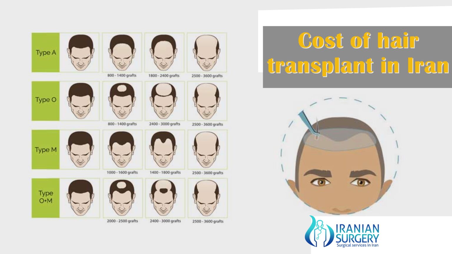 Hair Transplant in Iran | process + Cost [Best Clinic ️]