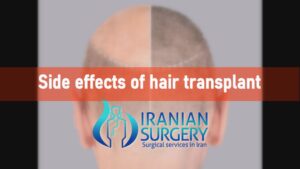 What are the risks and Side effects of hair transplant?