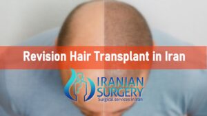 Revision Hair Transplant in Iran