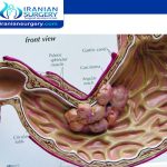 Stomach cancer surgery in Iran