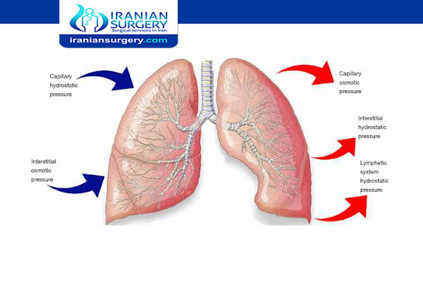 Sublobar resection (removal of part of lobe of the lung)