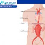 اعراض تمزق الشريان الاورطي البطني