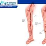 اعراض امراض الشرايين الطرفية