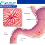 أعراض القرحة المعدیة