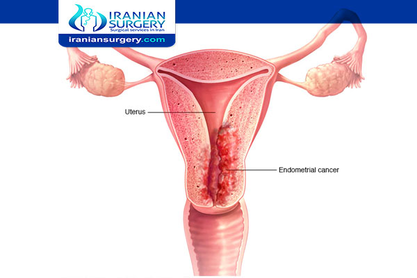 أعراض سرطان الرحم الحمید