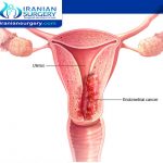 أعراض سرطان الرحم