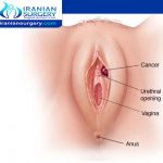 أعراض سرطان الفرج