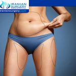 TYPES OF LIPOSUCTION