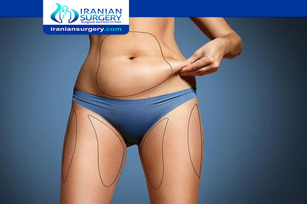 TYPES OF LIPOSUCTION 4