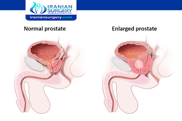 الفرق بين التهاب البروستاتا وسرطان البروستاتا ما الفرق بين تضخم البروستاتا وسرطان البروستاتا