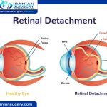 Eye retinal treatment