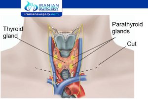 thyroidectomy surgery