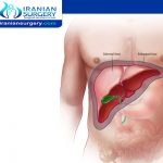 علاج تضخم الکبد