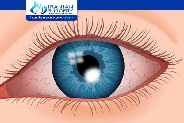 علاج قرحة القرنية العين
