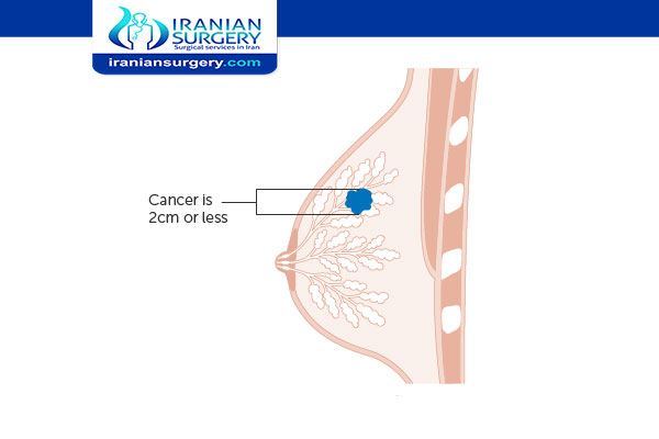 Treatment For Breast Cancer Stage 1