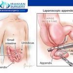 علاج التهاب الزائدة