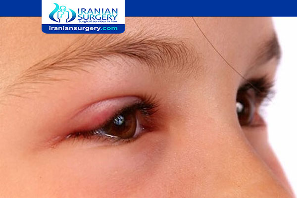 علاج انتفاخ العين عند الاطفال