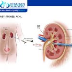 علاج حصوات الكلى في ایران