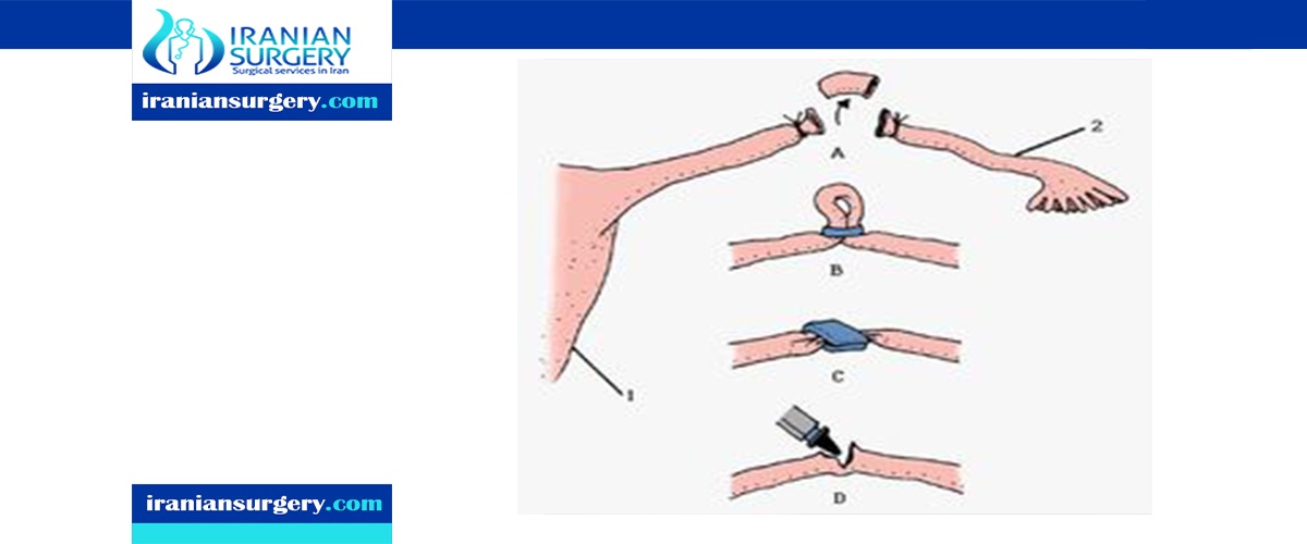 Tubal Ligation Reversal Before The Tubal Ligation Reversal Iranian Surgery