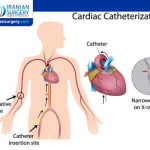انواع قسطرة القلب