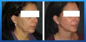 facelift surgery cost in Iran