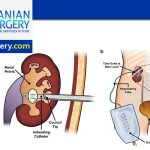 Ureteral Stenting and Nephrostomy procedure in Iran