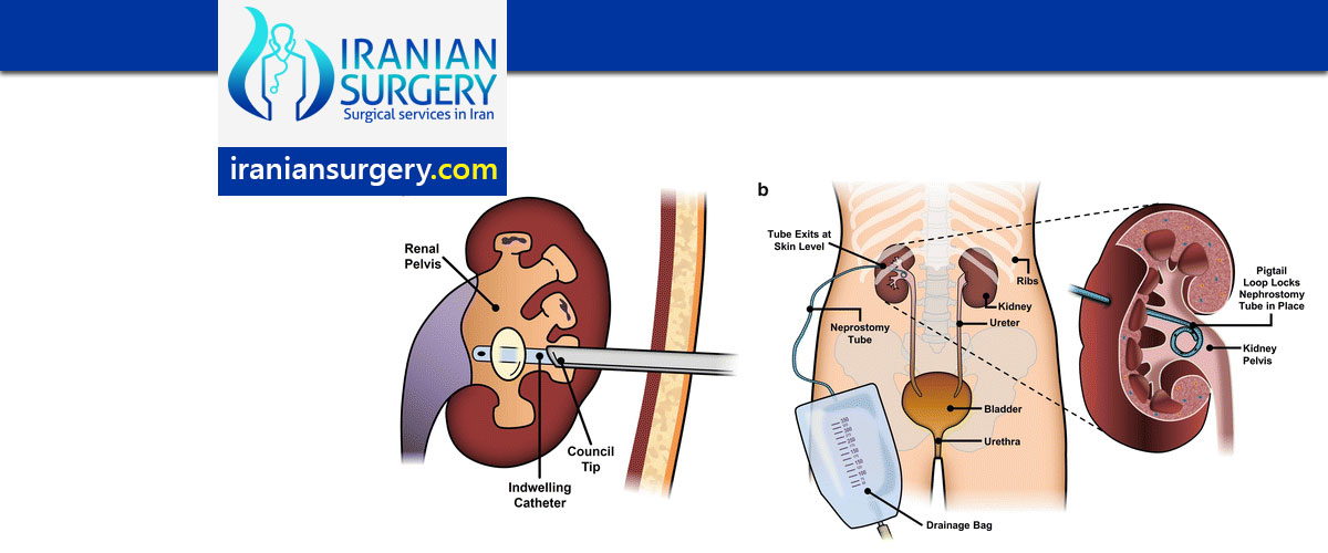 Ureteral Stenting and Nephrostomy procedure in Iran