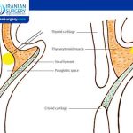 Vocal cord injection technique