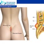 What are the causes of pilonidal sinus