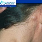 اعراض سرطان الغدد اللمفاوية خلف الاذن