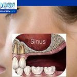 What can I expect after a sinus lift?
