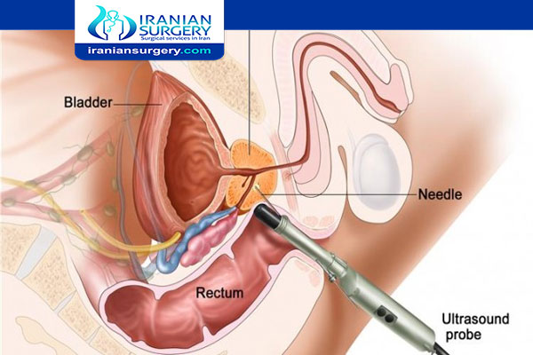 What happens when you have a prostate biopsy?