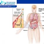 What is stage 3 rectal cancer?