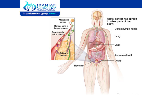 What is stage 3 rectal cancer?