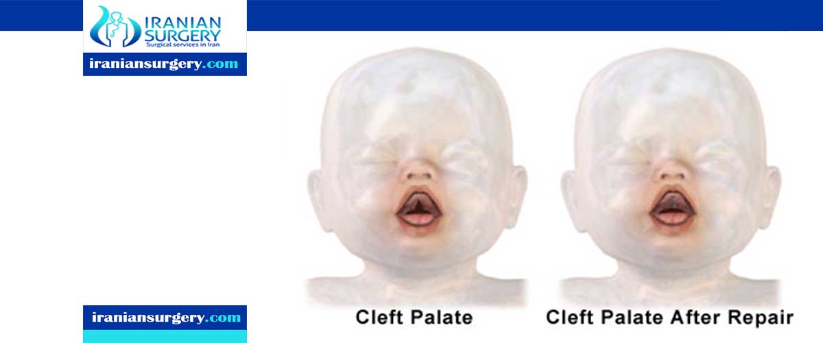 What to expect after cleft palate surgery