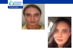 ethnic rhinoplasty in iran