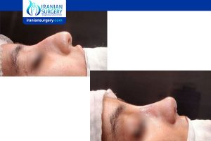 rhinoplasty in iran vs turkey