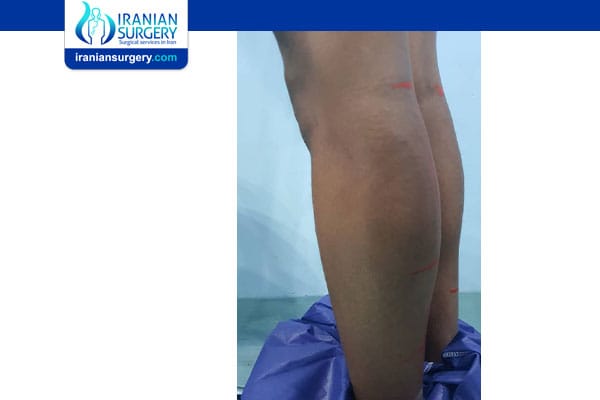 Calf implant surgery in Iran