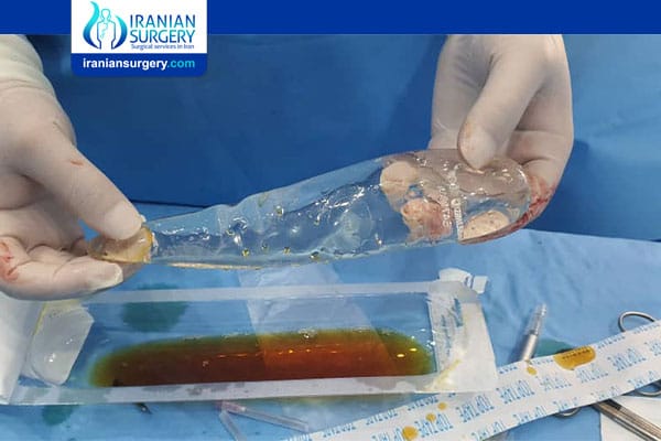Calf implant surgery in Iran